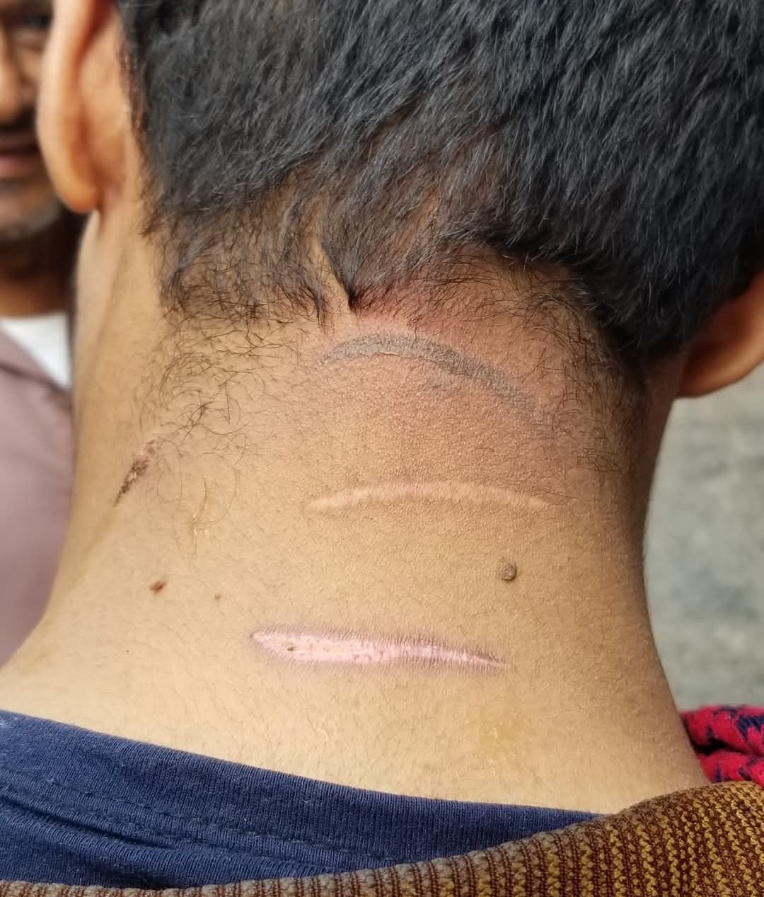 العلاج بالكي.. نار تحرق أجساد الأبرياء بريف اليمن