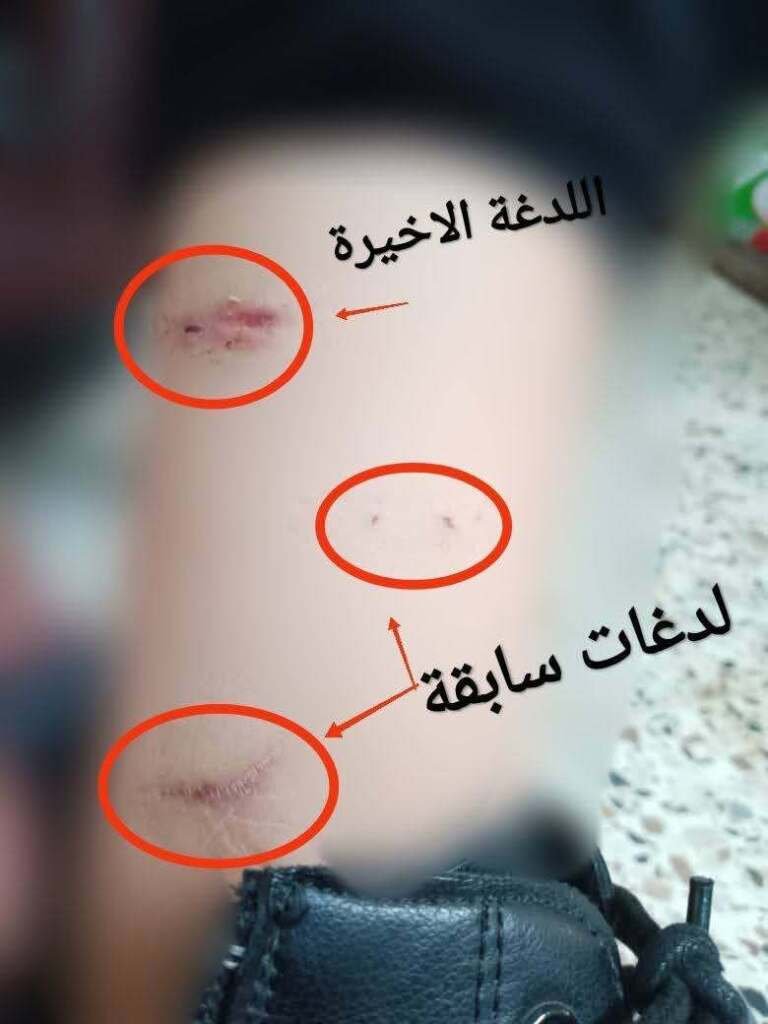 11 لدغة ثعبان في 3 أشهر.. القصة الكاملة لحادثة الطفلة أنسام